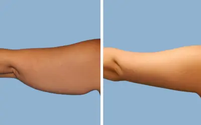 Before and After